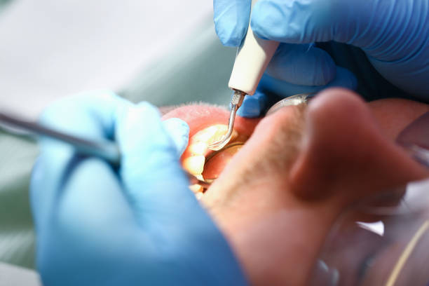 Best Emergency Treatment for Dental Infections or Abscesses in Crest, CA