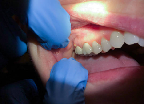 Best Urgent Care for Lost Fillings or Crowns in Crest, CA