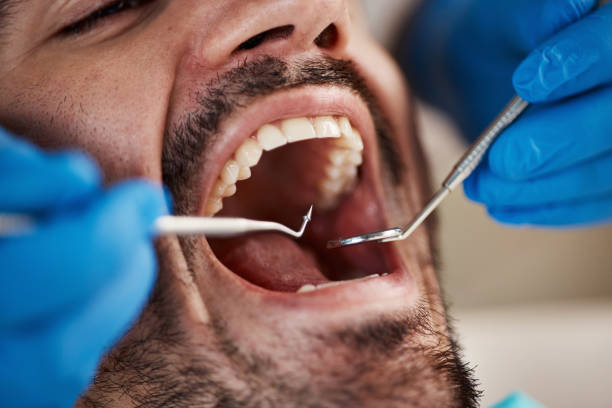 Best Emergency Wisdom Teeth Removal in Crest, CA